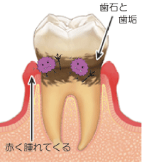 歯茎のこと